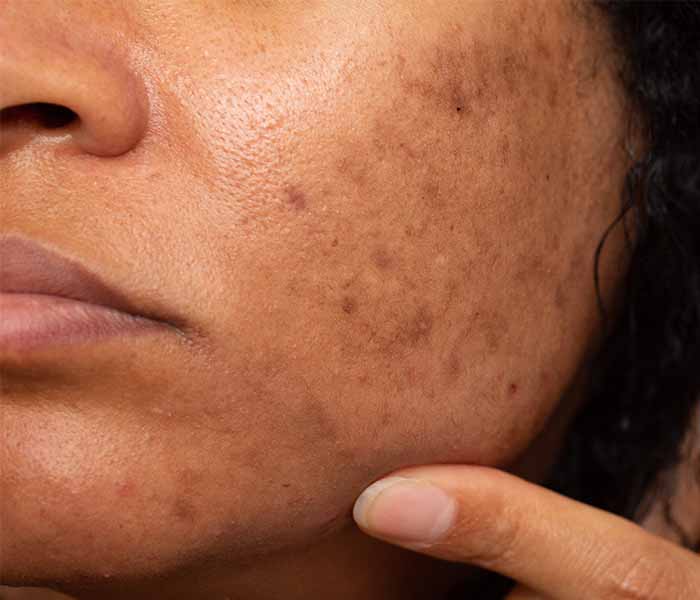Pigmentation Issues